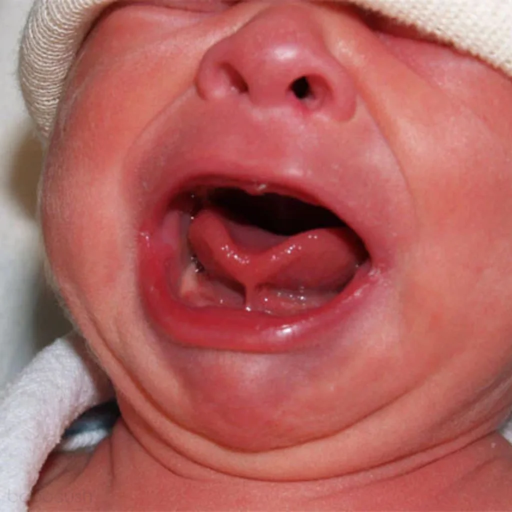 Lip tie clinical photo